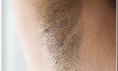 Hard Lumps In Armpit From Deodorant Best Reviews