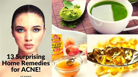 13 Surprising Home Remedies For Acne Youtube