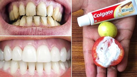 Magical Teeth Whitening Remedy How To Get White Teeth Fast At Home