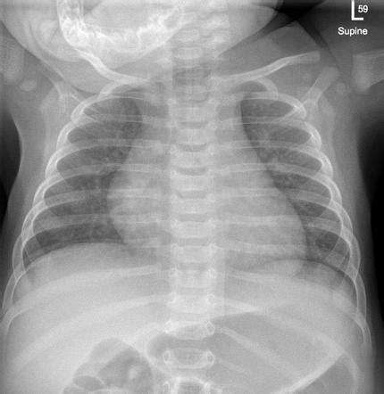 Normal Chest Radiograph Paediatric Under 1 Radiology Case