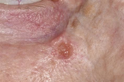 Basal Cell Carcinoma Stock Image C0498707 Science Photo Library
