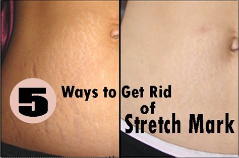How To Get Rid Of Stretch Marks Naturally Medi Tricks Stretch Marks