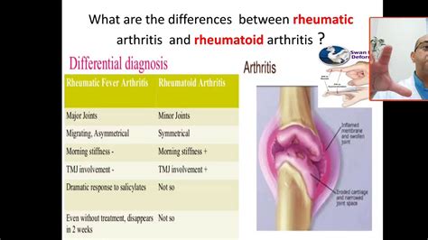 What Are The Differences Between Rheumatic Fever Arthritis And