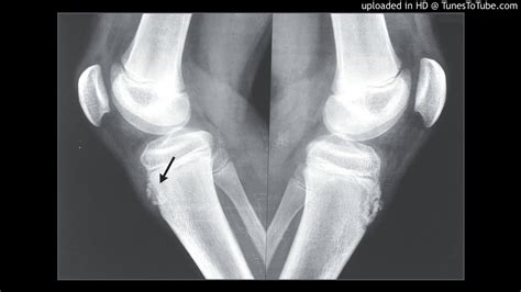 Osgood Schlatter Disease Youtube