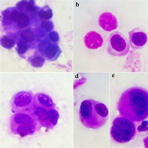 Papillary Urothelial Neoplasm Of Low Malignant Potential Punlmp Dog
