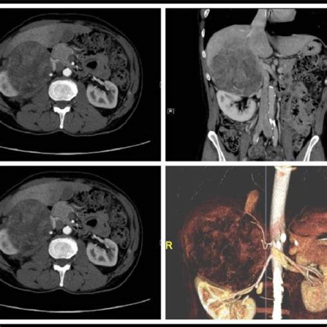 Sections Of The Ct Showing A Large Retroperitoneal Mass Focal Absence