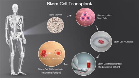 Stemcelltransplant Iow47 Scientific Animations