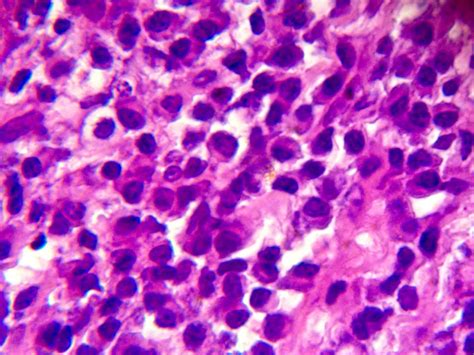 Histopathology Cervical Lymphadenopathy