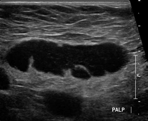 Ultrasound Exam Of Right Axilla There Is Diffuse Cortical Thickening