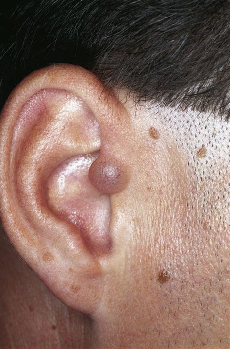 Cutaneous Lesions Of The External Ear Head And Face Medicine Full Text
