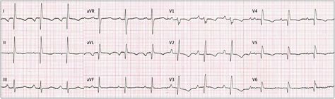 Electrocardiographic Findings In A Woman With Dextrocardia And Cyanosis