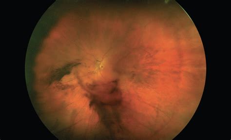 Vitreous Hemorrhage Observe Or Operate Retina Today