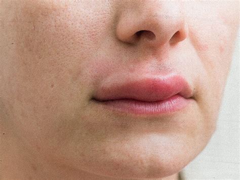 How To Treat A Busted Lip Renew Physical Therapy