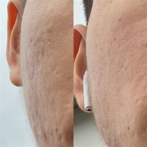 Skin Concerns Acne Scar Progress Rskincareaddiction