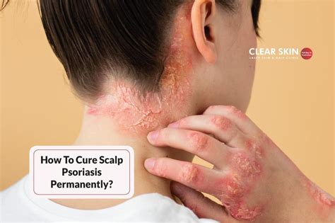 How To Cure Scalp Psoriasis Permanently Clear Skin Clinic