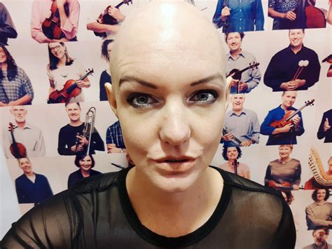 Mum Of Two Reveals What Its Like To Live With Alopecia New Idea Magazine