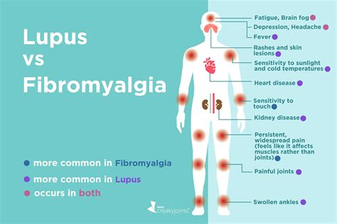 Fibromyalgia Vs Lupus Whats The Difference