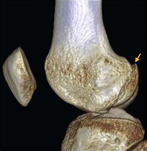 Fracture Of The Lateral Femoral Condyle Journal Of Orthopaedic Sports Physical Therapy