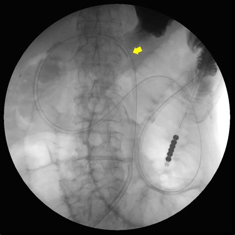 Transgastric Decompression Using A Newly Developed Nasojejunal Tube In