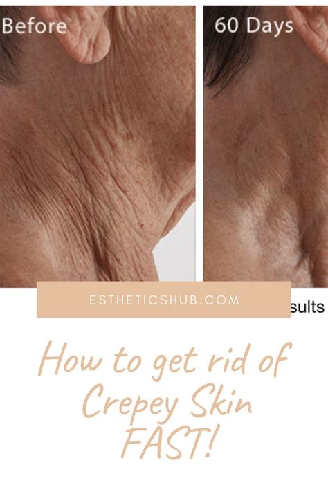 How To Get Rid Of Crepey Skin On Legs And Arms Clarine Westmoreland