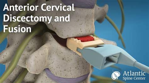 Anterior Cervical Discectomy And Fusion Youtube