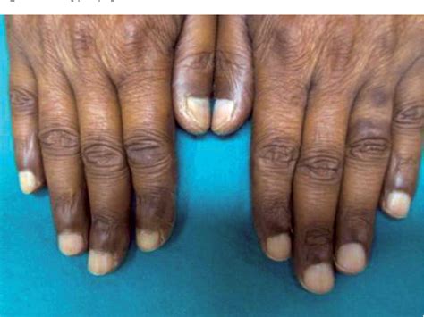 Figure 1 From An Unusual Case Of Capecitabine Hyperpigmentation Is