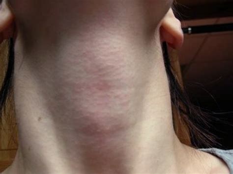 Itchy Neck Pictures Symptoms Treatment Rash Causes December