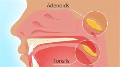 Adenoiditis Causes Who Is At Risk Signs And Symptoms Diagnosis