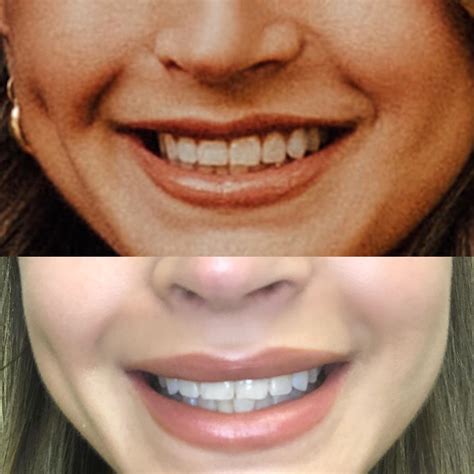 Before And After Botox In My Upper Lip R30plusskincare