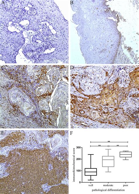 Immunohistochemical staining of stathmin in normal and primary oral 