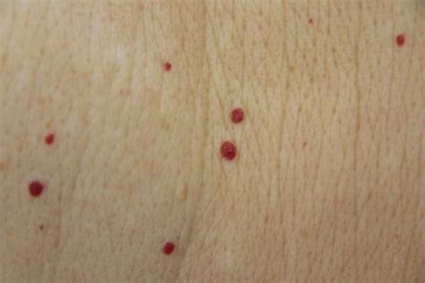 Do You Have These Red Spots On Your Body Should You Worry Read What