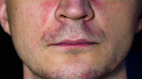 Perioral Dermatitis Symptom