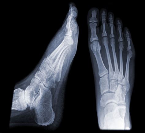 Metatarsal Stress Fracture Mechanism Of Injury Signs And Treatment