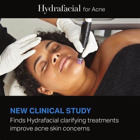 Hydrafacial Treatments Improve Acne