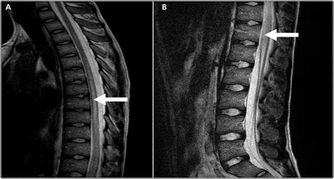 Transverse implies that the inflammation extends horizontally across the spinal cord. Transverse Myelitis Symptoms, Causes, Diagnosis and ...