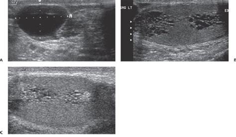 153 Tubular Ectasia Of The Rete Testes Radiology Key