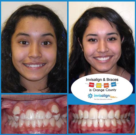 Before And After Patients Cases│invisalign And Braces In Orange County