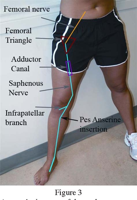 Figure From Entrapment Of The Saphenous Nerve At The Adductor Canal Affecting The