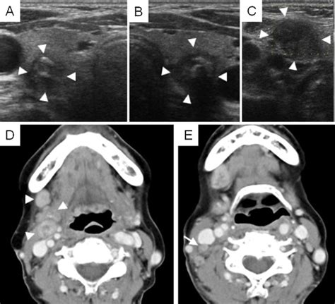 Preoperative Ultrasonographic And Enhanced Ct Study Of The Tumor The