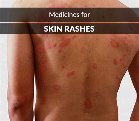 Medicine For Skin Allergy Itching Ampicillin Or Amoxicillin Rash