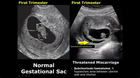 Uterus Ultrasound Normal Pregnancy Vs Miscarriage Image Appearances