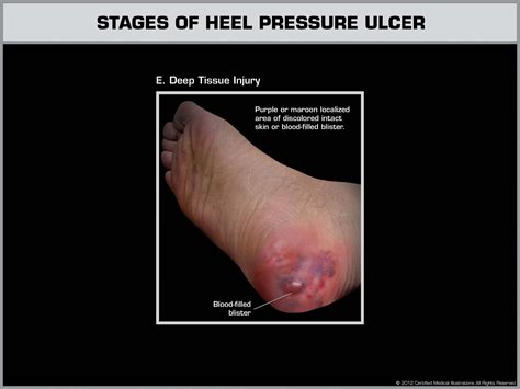 Heel Pressure Ulcer Stages Images And Photos Finder