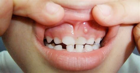 What Are Gum Boils And Causes How Can They Be Treated