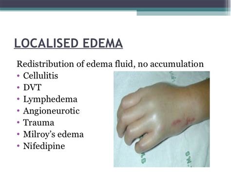 Clinical Features Of Edema