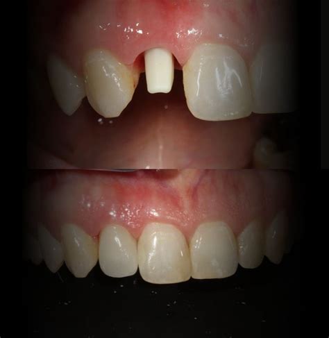 O Que São Implantes Dentários De Zircónia Dentalcore