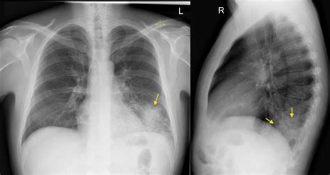 Normal Lateral Chest X Ray Male