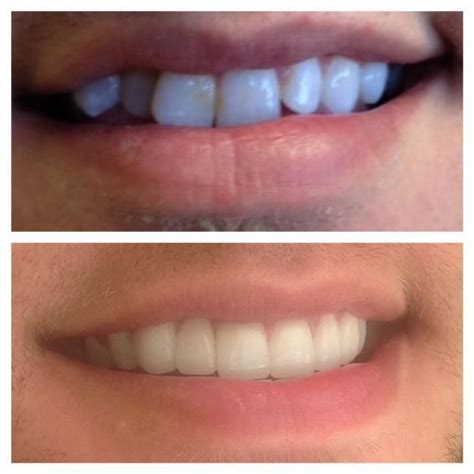 Porcelain Veneers Are Instant Orthodontics Find Out How To Combat