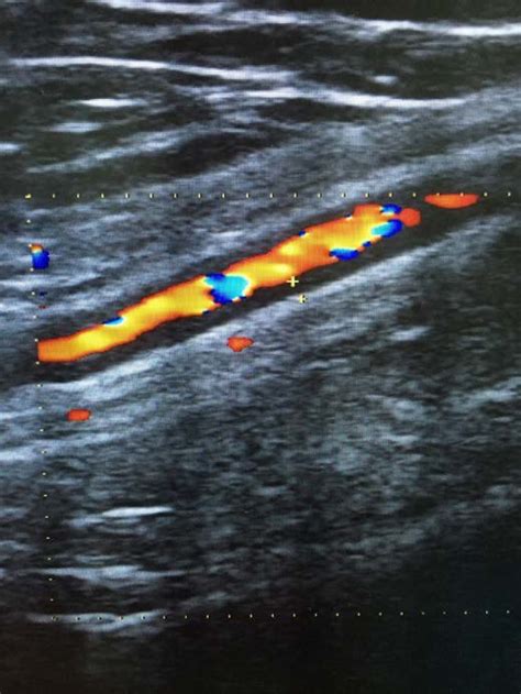 Left Axillary Artery Ultrasound Longitudinal View At 10 Weeks Of