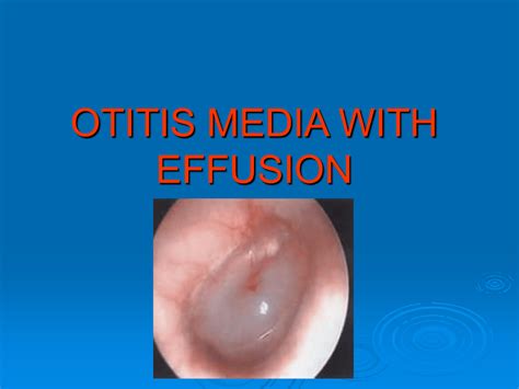 Otitis Media With Effusion Otitis Media With Effusion Of The Right