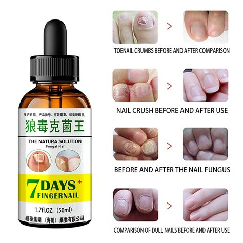 Fungal Nail Repair Essence Serum Care Treatment Foot Nail Fungus Removal Anti Infection